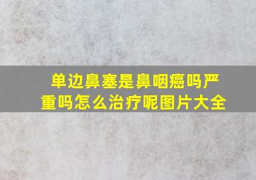 单边鼻塞是鼻咽癌吗严重吗怎么治疗呢图片大全