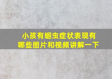 小孩有蛔虫症状表现有哪些图片和视频讲解一下