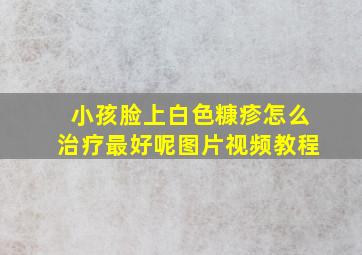 小孩脸上白色糠疹怎么治疗最好呢图片视频教程