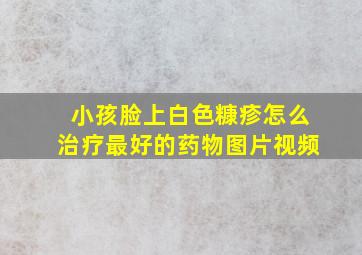 小孩脸上白色糠疹怎么治疗最好的药物图片视频