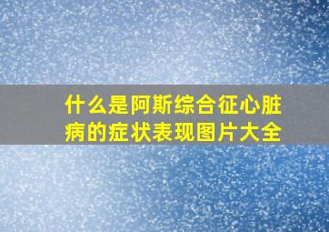 什么是阿斯综合征心脏病的症状表现图片大全