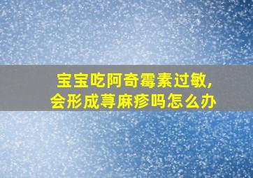 宝宝吃阿奇霉素过敏,会形成荨麻疹吗怎么办