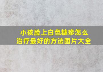 小孩脸上白色糠疹怎么治疗最好的方法图片大全