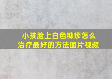 小孩脸上白色糠疹怎么治疗最好的方法图片视频