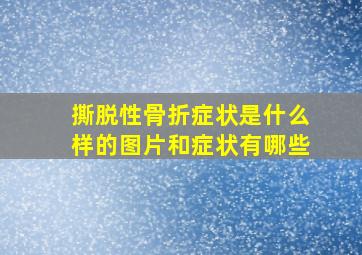 撕脱性骨折症状是什么样的图片和症状有哪些