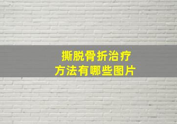 撕脱骨折治疗方法有哪些图片