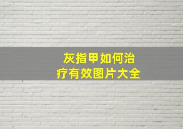 灰指甲如何治疗有效图片大全