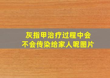 灰指甲治疗过程中会不会传染给家人呢图片