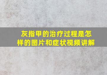 灰指甲的治疗过程是怎样的图片和症状视频讲解