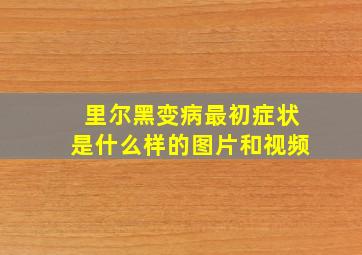 里尔黑变病最初症状是什么样的图片和视频