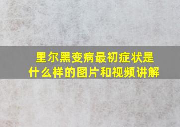 里尔黑变病最初症状是什么样的图片和视频讲解